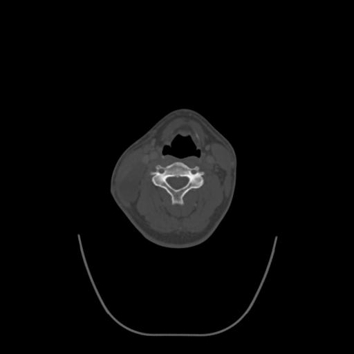 File:Branchial cleft cyst (Radiopaedia 31167-31875 Coronal bone window 1).jpg