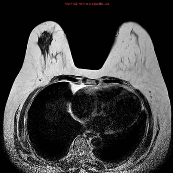 File:Breast carcinoma (multicentric multifocal in mammary Paget disease) (Radiopaedia 50966-56512 Axial T2 4).jpg