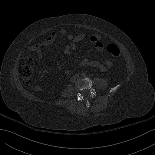 File:Breast carcinoma with pathological hip fracture (Radiopaedia 60314-67993 Axial bone window 4).jpg