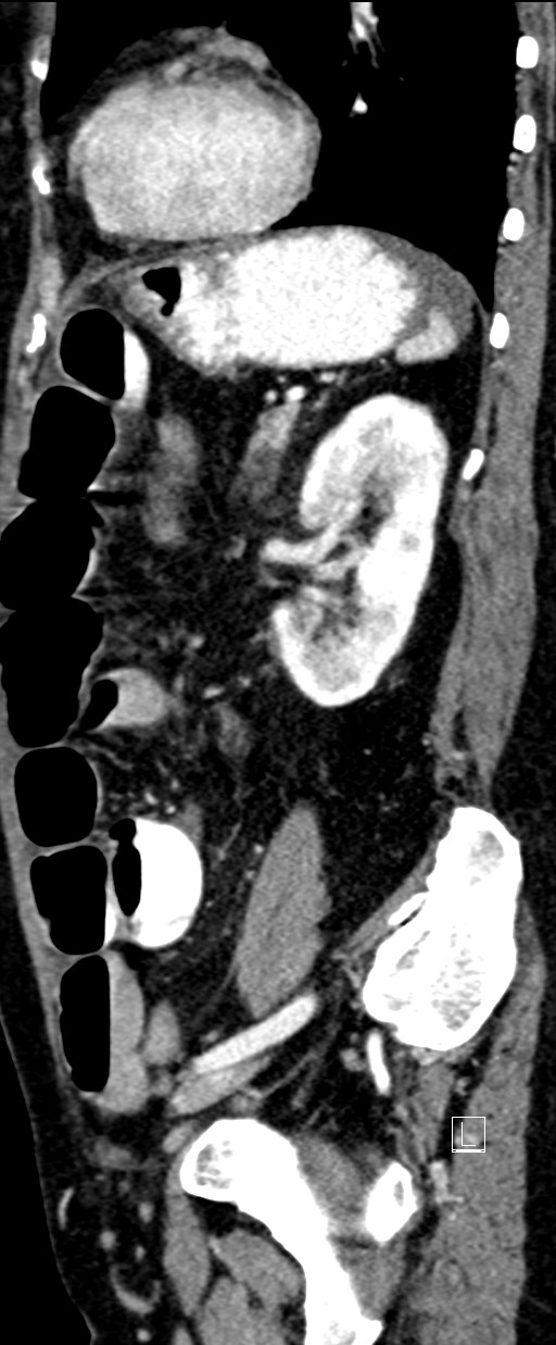 Broad ligament hernia (Radiopaedia 84802-100276 C 21).jpg