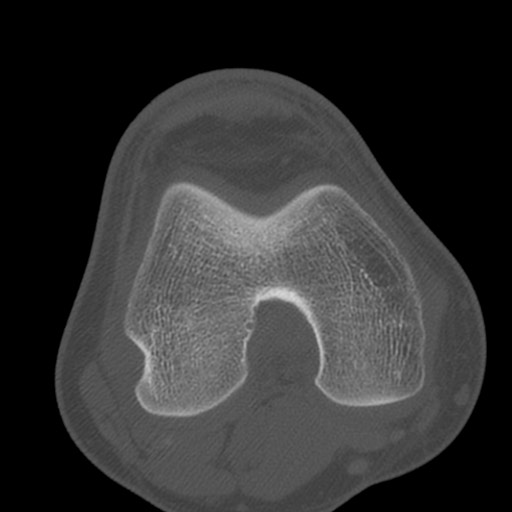 Brodie abscess of the tibia (Radiopaedia 58984-66250 Axial bone window 44).jpg