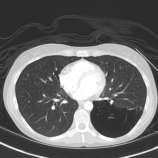 Bronchial atresia (Radiopaedia 73677-84470 Axial lung window 38).jpg