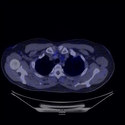 Bronchial carcinoid tumor (Radiopaedia 67377-76765 68Ga-DOTATATE PET-CT 20).jpg