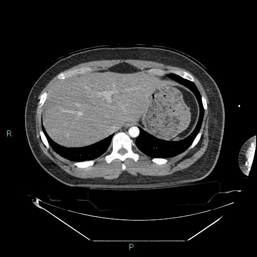 Bronchial carcinoid tumor (Radiopaedia 78272-90870 B 105).jpg