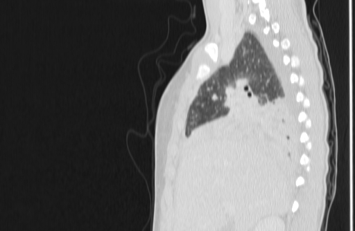 File:Bronchial mucoepidermoid carcinoma (Radiopaedia 57023-63895 Sagittal lung window 41).jpg