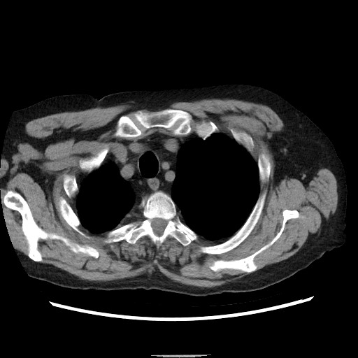 Bronchial stenosis - lung transplant (Radiopaedia 73133-83848 Axial non-contrast 11).jpg
