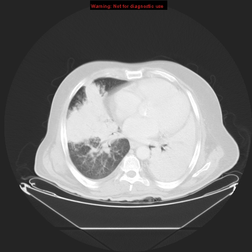 File:Bronchioloalveolar carcinoma (Radiopaedia 9272-9955 Axial lung window 19).jpg