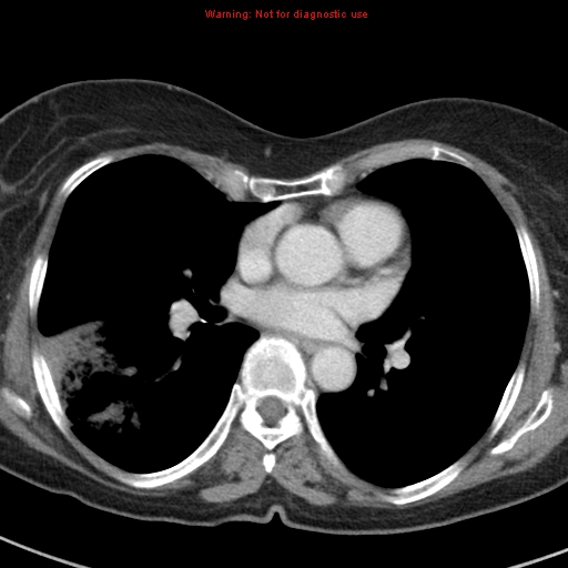 File:Bronchoalveolar carcinoma (BAC) (Radiopaedia 13436-13392 B 29).jpg