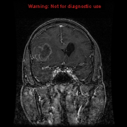 File:Bronchogenic carcinoma brain metastasis (Radiopaedia 9286-9969 Coronal T1 27).jpg