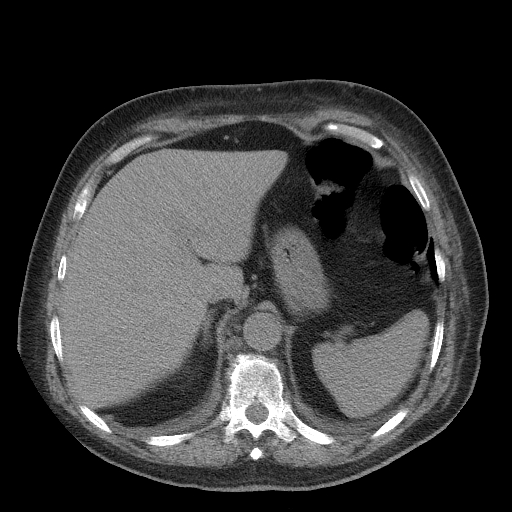 Bronchogenic carcinoma with metastatic lymphadenopathy (Radiopaedia 37671-39569 Axial non-contrast 51).jpg