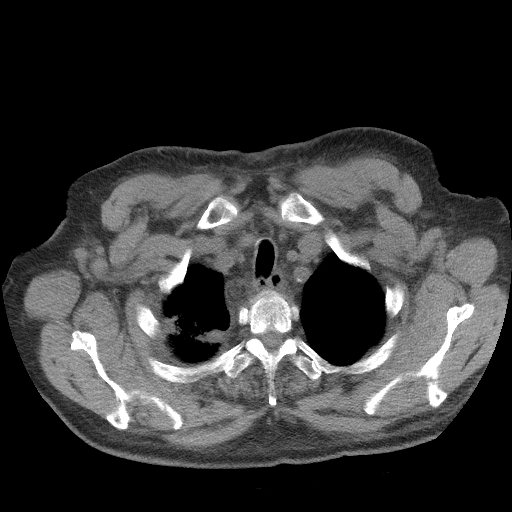 Bronchogenic carcinoma with metastatic lymphadenopathy (Radiopaedia 37671-39569 Axial non-contrast 8).jpg