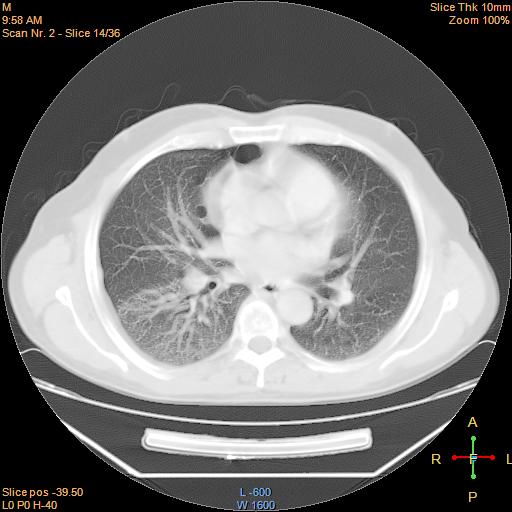 File:Bronchogenic carcinoma with superior vena caval invasion (Radiopaedia 22378-22406 lung window 11).jpg