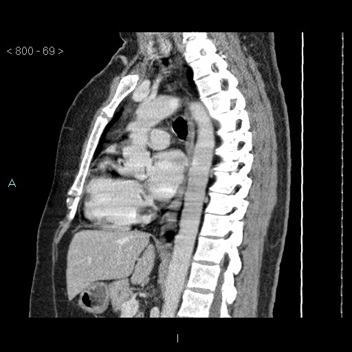 Bronchogenic cyst - posterior mediastinal (Radiopaedia 43885-47364 B 46).jpg