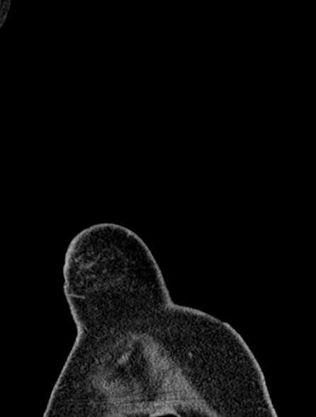 Bronchus suis (Radiopaedia 39631-41953 Coronal non-contrast 1).jpg
