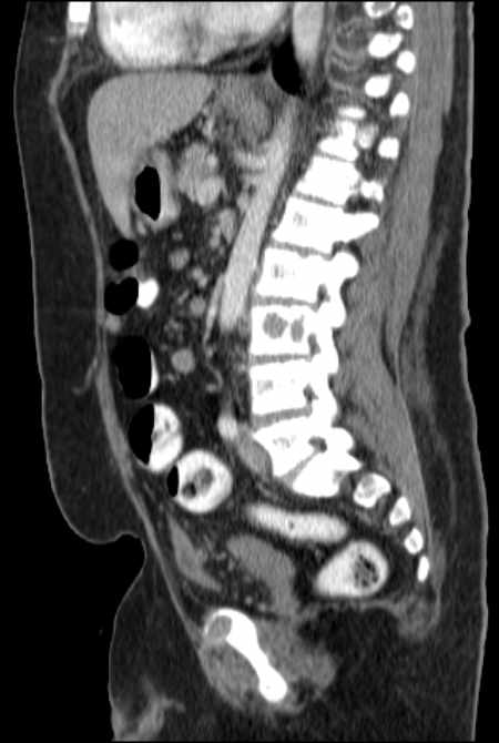 Brown tumors compressing the spinal cord (Radiopaedia 68442-77988 F 32).jpg