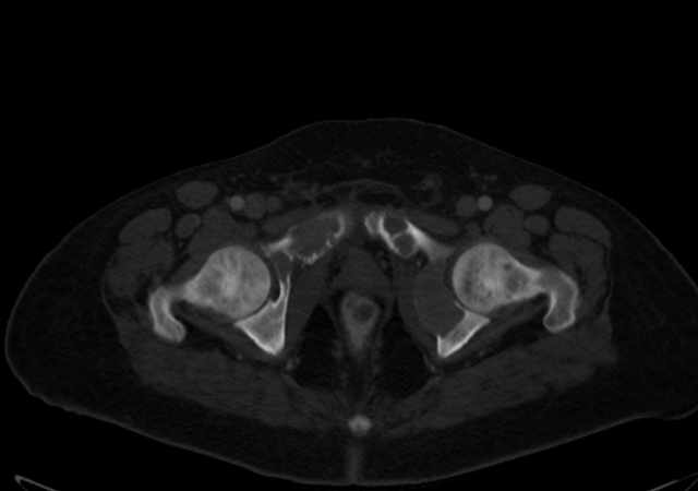 Brown tumors compressing the spinal cord (Radiopaedia 68442-77988 G 124).jpg