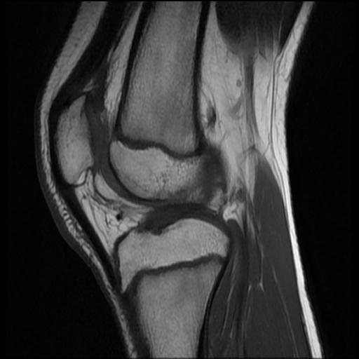 File:Bucket handle tear - lateral meniscus (Radiopaedia 72124-82634 Sagittal T1 7).jpg