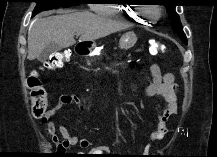 Buried bumper syndrome - gastrostomy tube (Radiopaedia 63843-72577 Coronal Inject 46).jpg