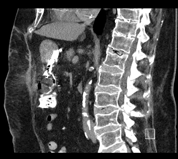 Buried bumper syndrome - gastrostomy tube (Radiopaedia 63843-72577 Sagittal Inject 62).jpg