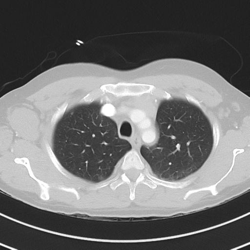Burkitt lymphoma (Radiopaedia 34686-36121 Axial lung window 12).png