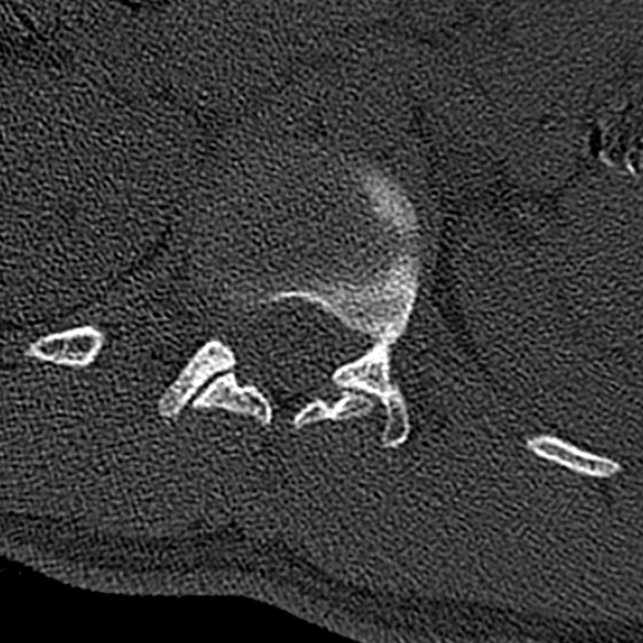 Burst fracture (Radiopaedia 53373-59357 Axial bone window 7).jpg