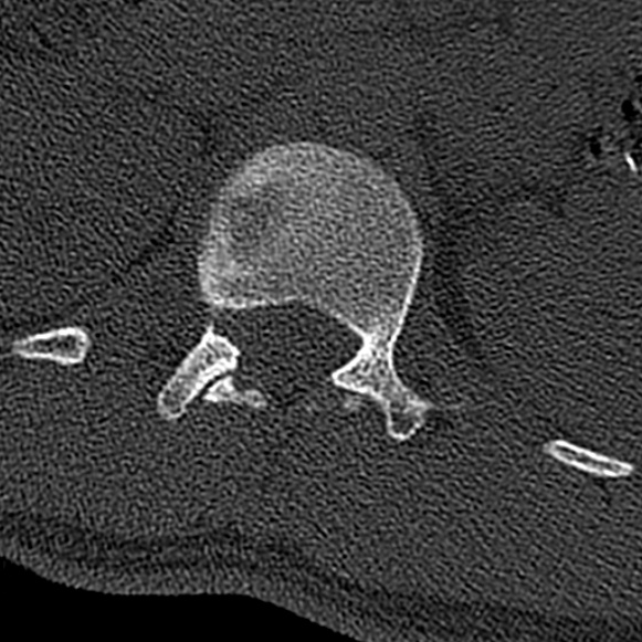 Burst fracture (Radiopaedia 53373-59357 Axial bone window 8).jpg