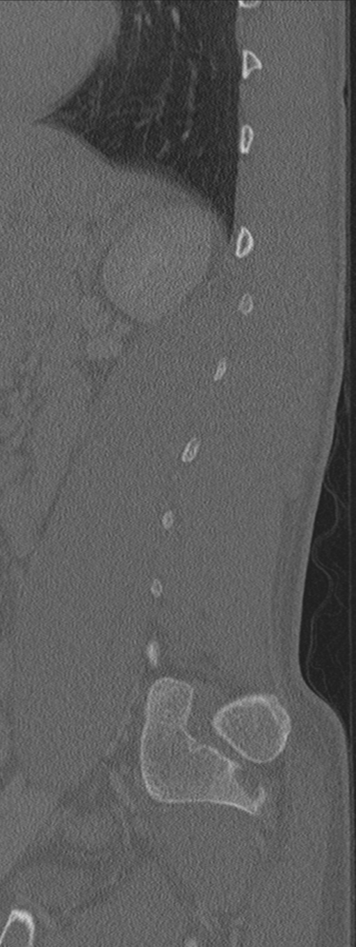 Burst fracture - T12 with conus compression (Radiopaedia 56825-63647 Sagittal bone window 17).png