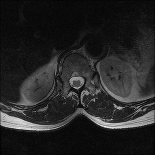 File:Burst fracture - lumbar spine (Radiopaedia 72877-83541 Axial T2 1).jpg