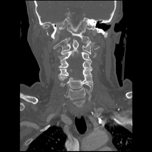 C1 anterior arch (plough) fracture - type 1 (Radiopaedia 76181-87720 Coronal bone window 53).jpg