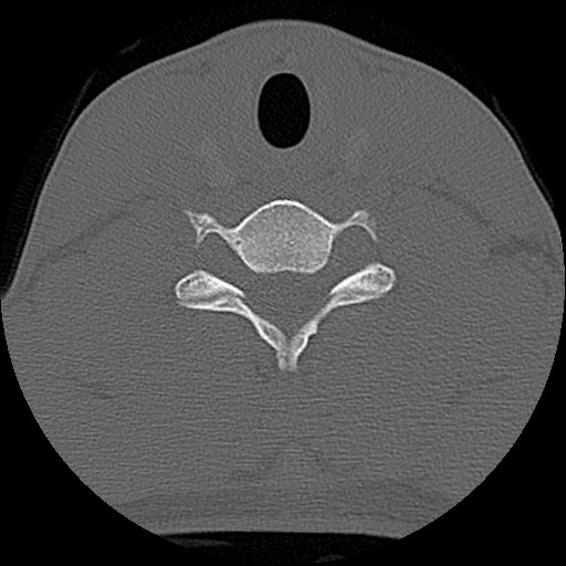 File:C5 facet fracture (Radiopaedia 58374-65499 Axial bone window 65).jpg