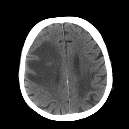 File:CNS lymphoma (Radiopaedia 36983-38639 Axial non-contrast 26).png