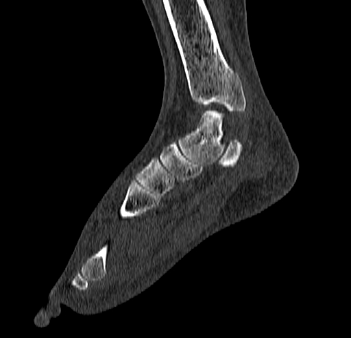 File:Calcaneal fracture - Sanders type 4 (Radiopaedia 90179-107370 Sagittal bone window 39).jpg