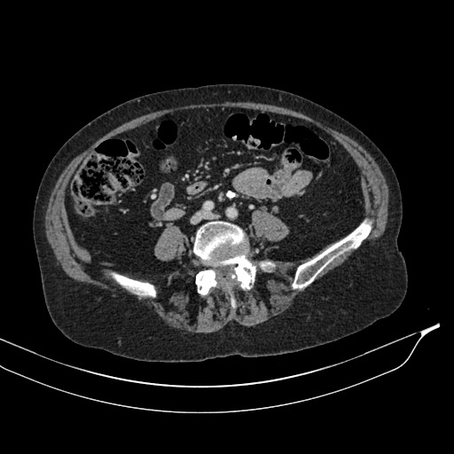 Calcified adrenal glands and Spigelian hernia (Radiopaedia 49741-54988 A 140).jpg