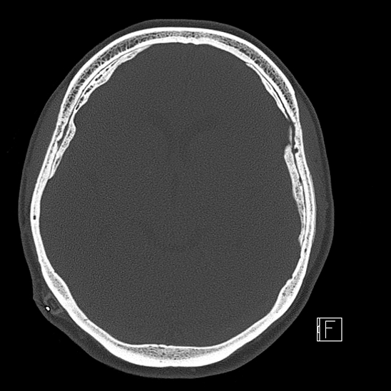 Calcified chronic subdural hematoma (Radiopaedia 77374-89492 Axial bone window 60).jpg