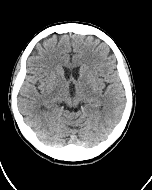 Calcified meningioma (Radiopaedia 74361-85243 Axial non-contrast 28).jpg