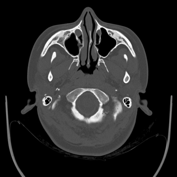 Calvarial osteoma (Radiopaedia 36520-38079 Axial bone window 12).jpg