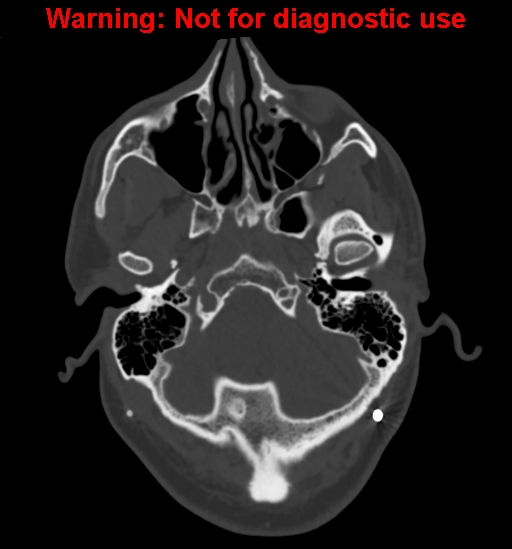 Calvarial thickening from chronic shunting (Radiopaedia 60079-67637 Axial bone window 26).jpg