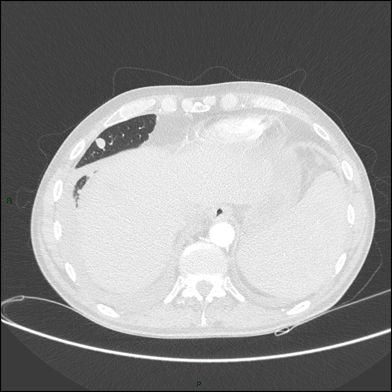 Cannonball metastases (Radiopaedia 82110-96150 Axial lung window 158).jpg