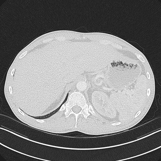 Cannonball metastases - testicular choriocarcinoma (Radiopaedia 84510-99891 Axial lung window 89).jpg