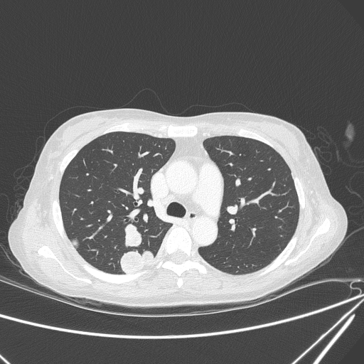 Canonball lung metastasis (Radiopaedia 77634-89837 Axial lung window 65).jpg
