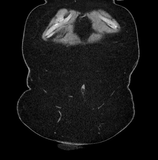 Carcinoid tumor - terminal ileum (Radiopaedia 60931-68740 Coronal non-contrast 2).jpg