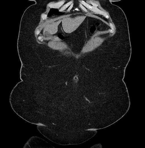 Carcinoid tumor - terminal ileum (Radiopaedia 60931-68740 Coronal non-contrast 8).jpg