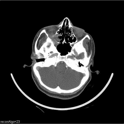 File:Carcinoma of the maxillary antrum (Radiopaedia 53805-59888 Axial C+ delayed 60).jpg