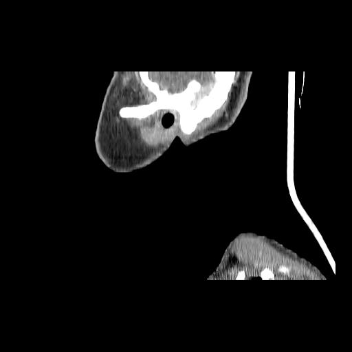 Carcinoma of the maxillary antrum (Radiopaedia 53805-59888 Sagittal C+ delayed 25).jpg