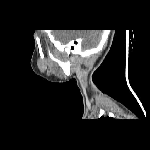 Carcinoma of the maxillary antrum (Radiopaedia 53805-59888 Sagittal C+ delayed 39).jpg