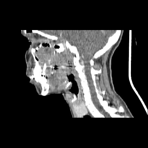 Carcinoma of the maxillary antrum (Radiopaedia 53805-59888 Sagittal C+ delayed 81).jpg