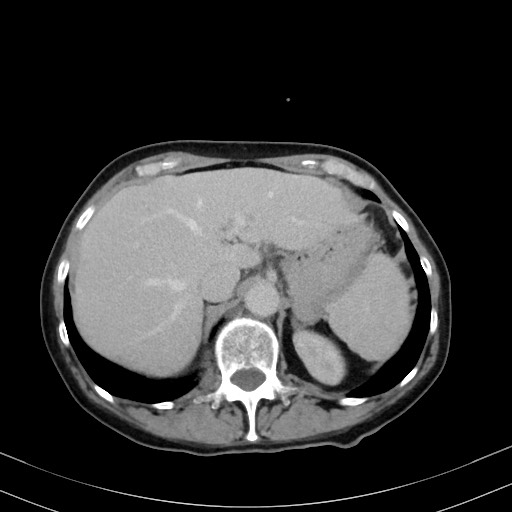 Carcinosarcoma (Radiopaedia 70401-80503 A 13).jpg
