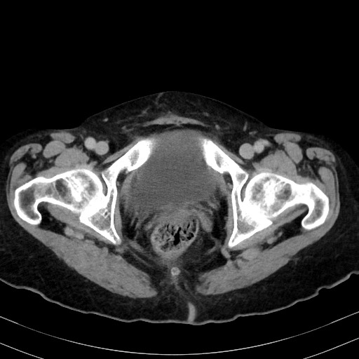 Carcinosarcoma (Radiopaedia 70401-80503 A 66).jpg