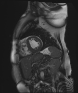 Cardiac amyloidosis (Radiopaedia 51404-57150 Sagittal CINE SSFP 143).jpg