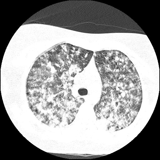 Cardiac angiosarcoma (Radiopaedia 66010-75181 Axial lung window 64).jpg